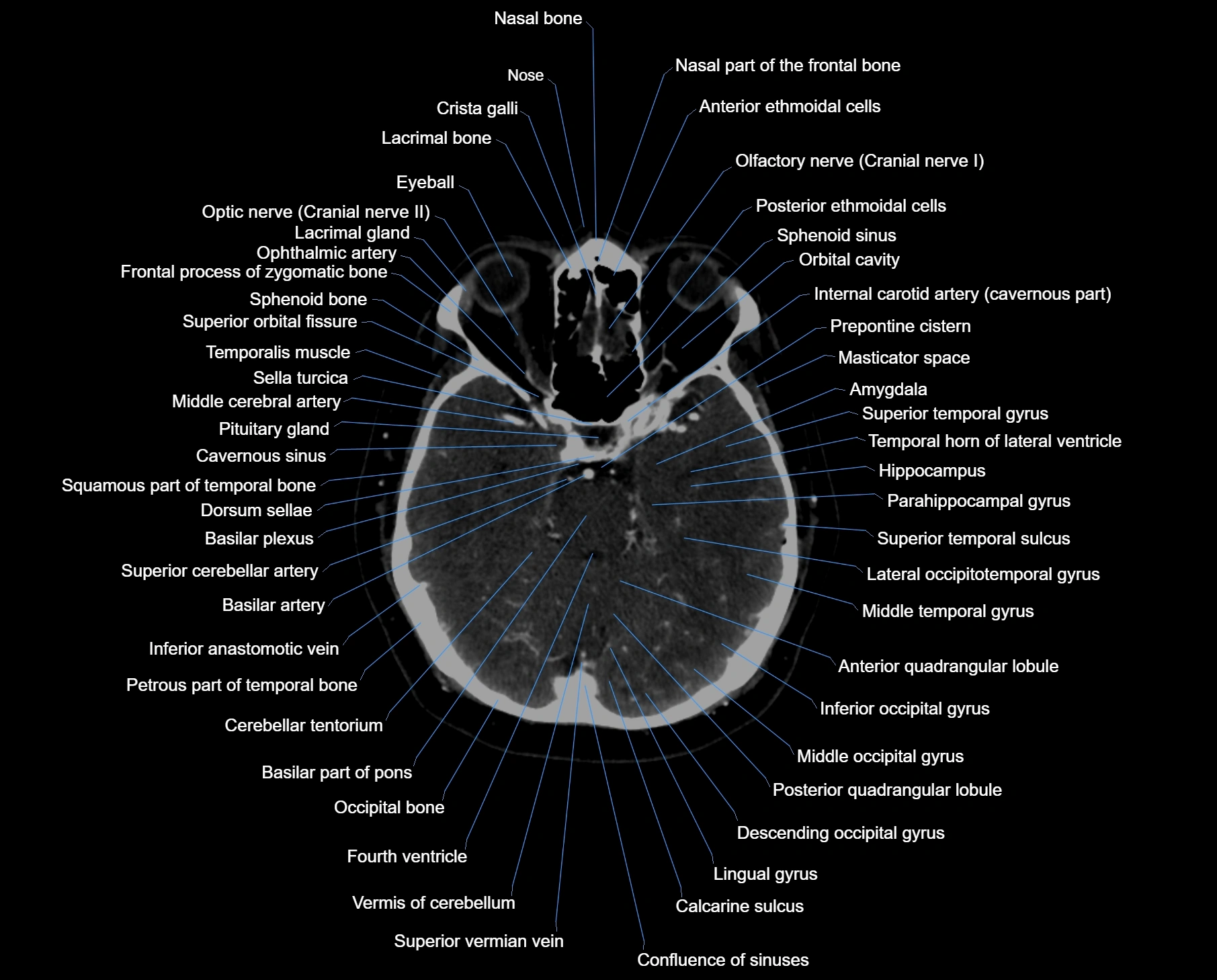 CT scan brain axial labelled cross sectional anatomy image-img-000024.webp